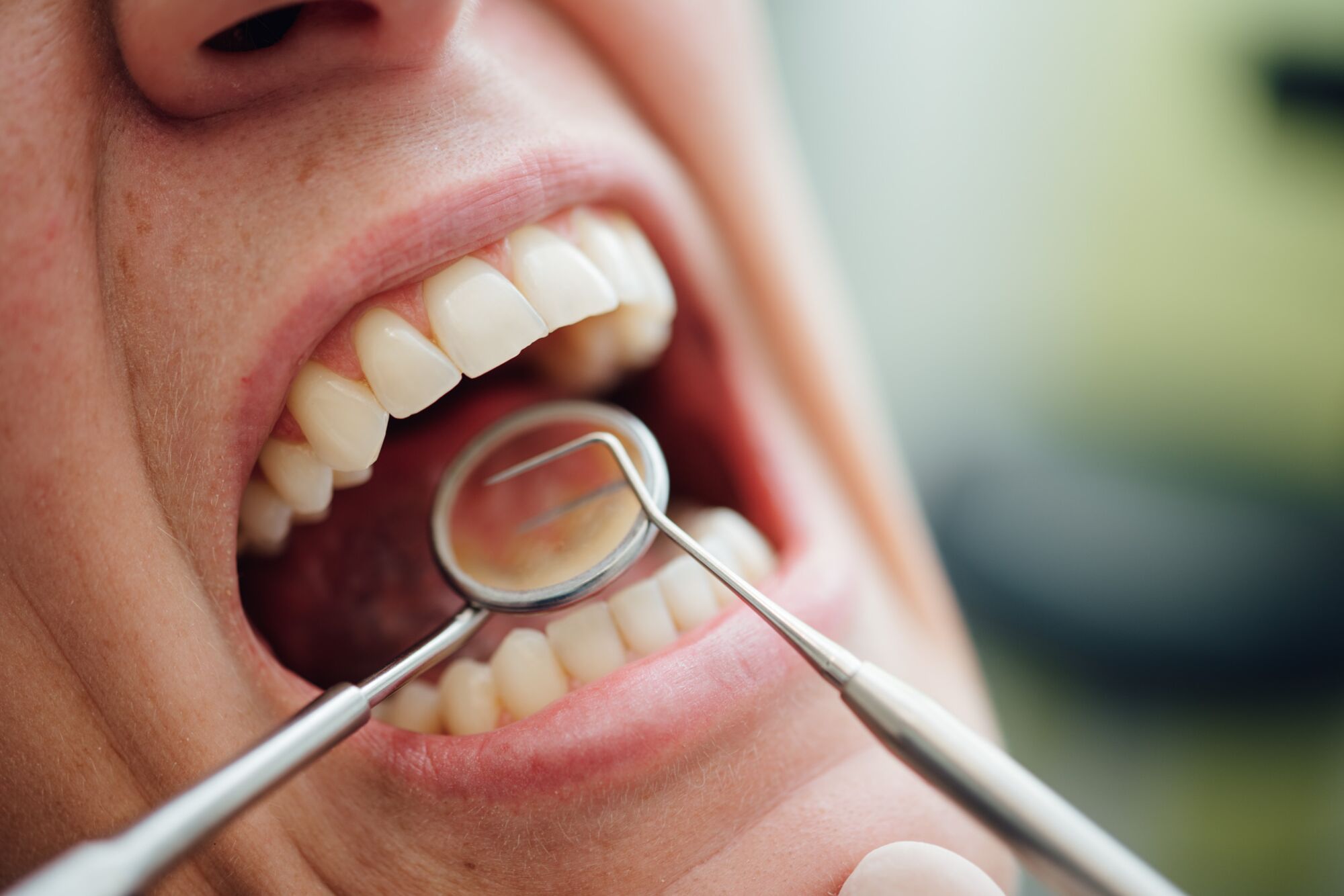 ZAHNFLEISCH/ÄSTHETIK